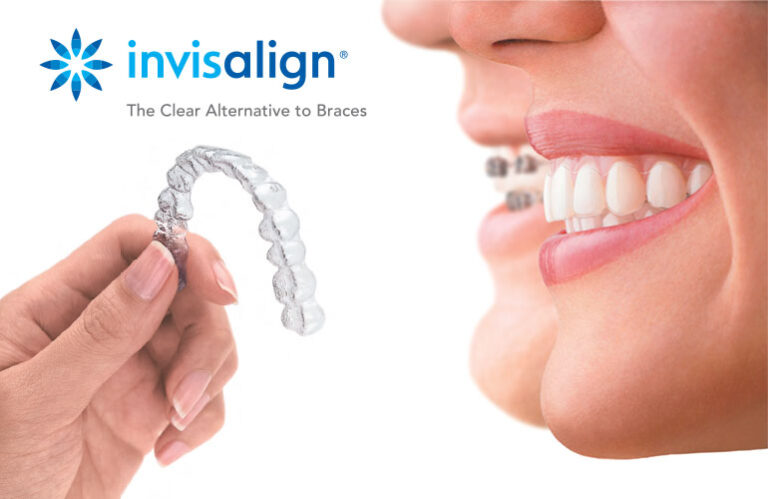 Invisalign