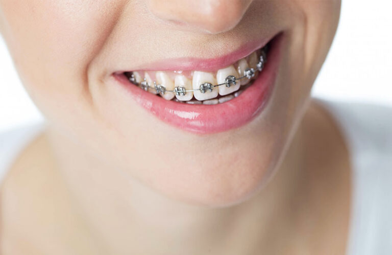 Best Metal Braces in Dubai