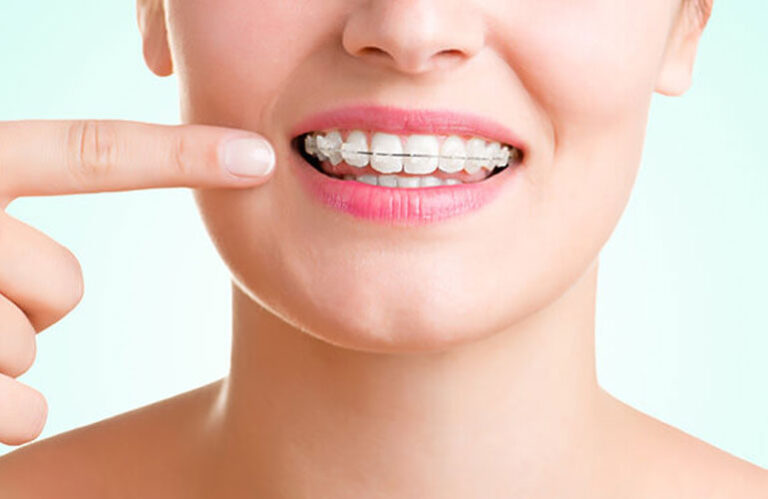 Ceramic Braces Treatment